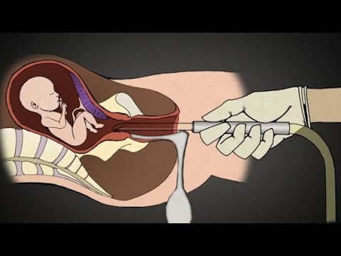 **GRAPHIC VIDEO** In the event you knew what abortions at 15 weeks have been like, you’d be in opposition to abortion.